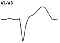 ECG criteria LBBB without STEMI infarction (V1-V3)