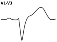ECG criteria LBBB without STEMI infarction (V1-V3)