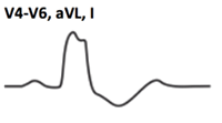 ECG criteria LBBB without STEMI infarction (V4-V6, aVL, I)