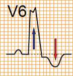 ECG criteria LBBB without STEMI (V6), ST depression