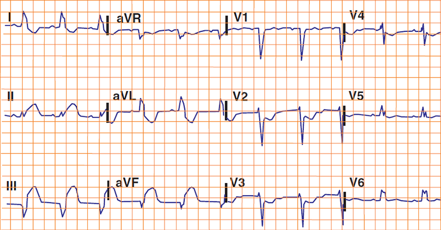 ECG Sgarbossa Criteria, acute STEMI and LBBB, Concordant ST depression greater than 1 mm in V1-V3 (score 3)