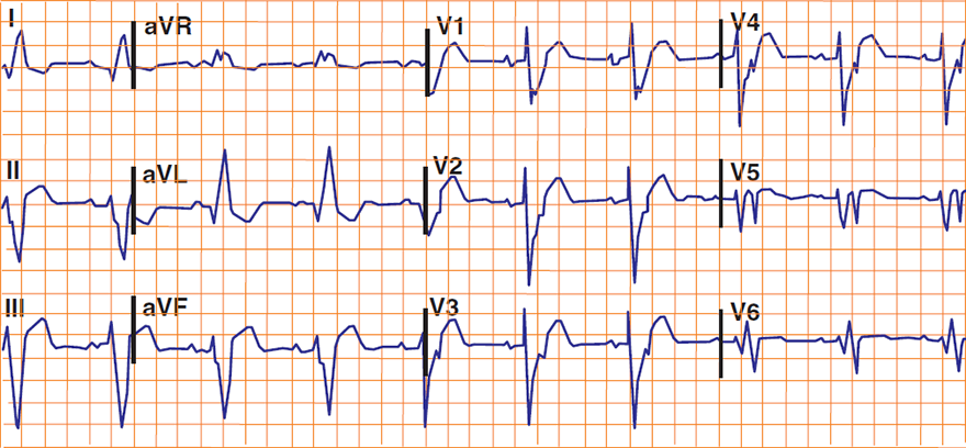 ECG Sgarbossa Criteria, acute STEMI and LBBB, Excessively discordant ST elevation greater than 5 mm