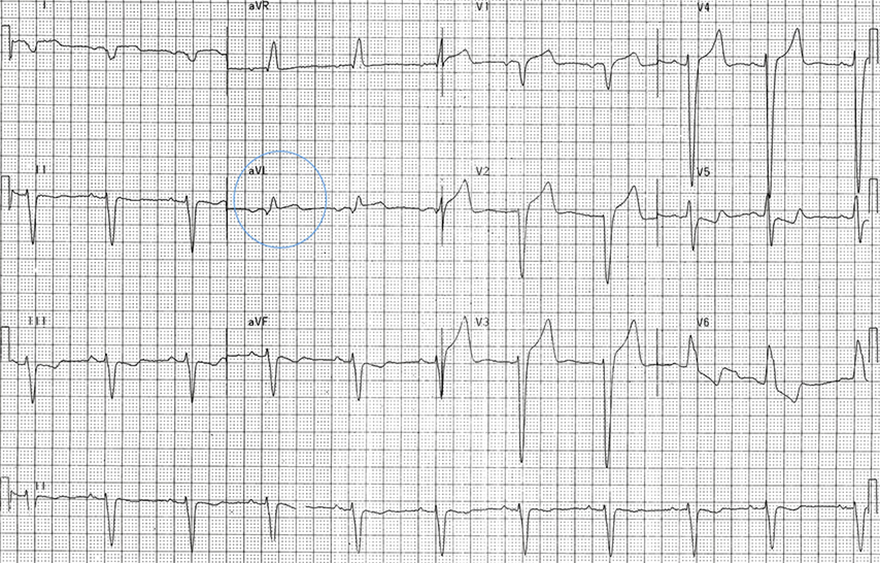 ECG positive sgarbossa criteria with LBBB, 1mm concordant ST elevation in aVL