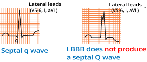 LBBB and septal Q wave