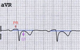 ECG pericarditis Reciprocal PR elevation and ST depression in aVR