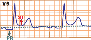 ECG pericarditis PQ PR segment depression and concave ST elevation