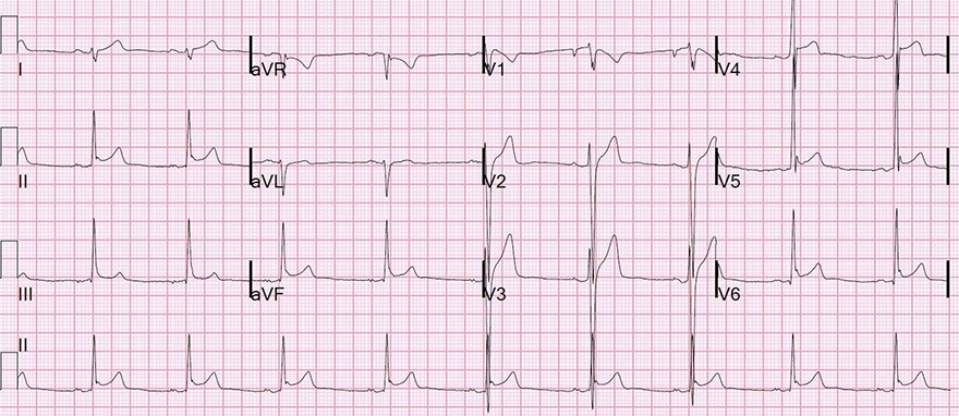 ECG benign early repolarisation, concave ST elevation, J wave, J point, peaked T waves, fish hook pattern