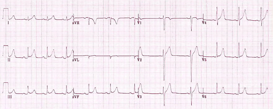 ECG benign early repolarisation, J wave notch, fish hook pattern