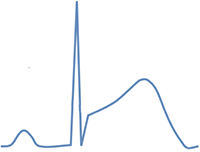 ECG classic benign early repolarization without a J wave