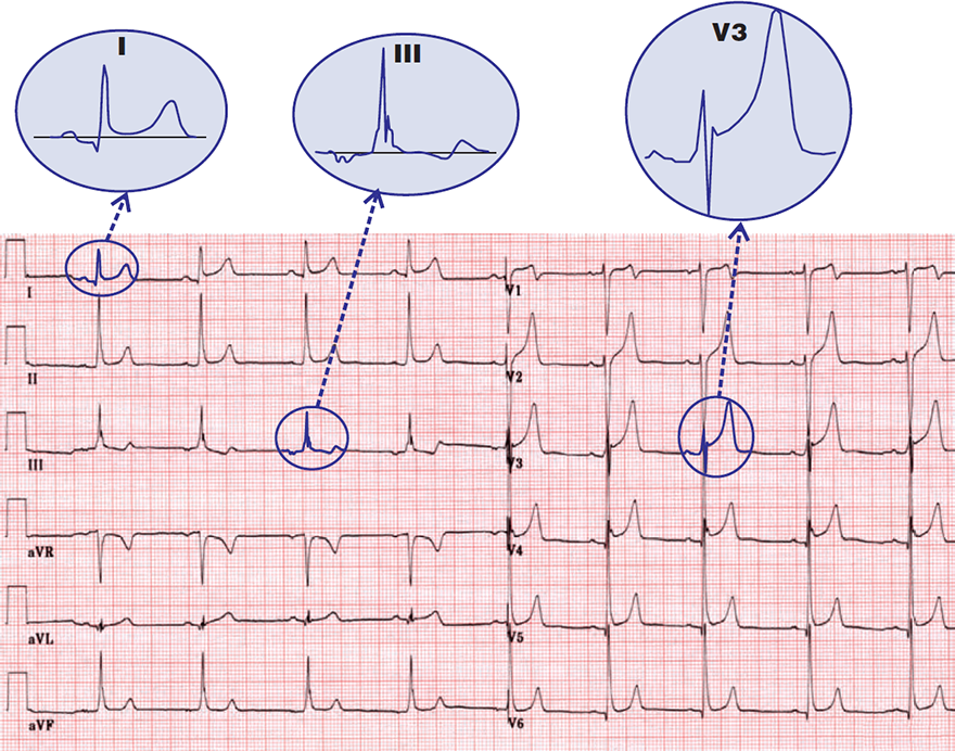 ECG benign early repolarisation, concave ST elevation, fish hook pattern, ST T ratio, J wave notch