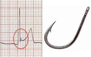 ECG J wave notch, fish hook pattern, benign early repolarisation