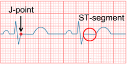 ECG J point, ST elevation, ST segment
