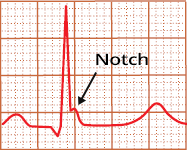 ECG inferior lateral benign early repolarisation, J wave notch