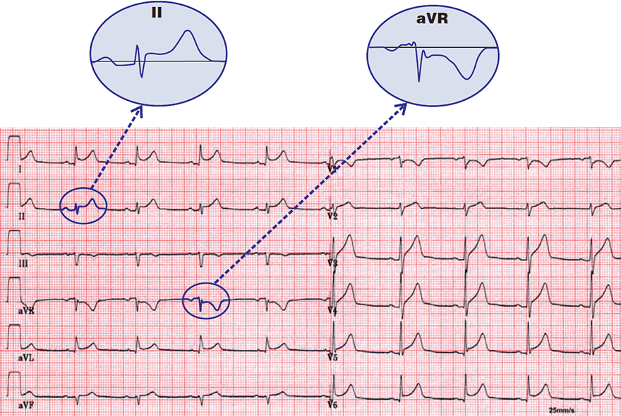 ECG pericarditis, concave ST elevation, spodick sign
