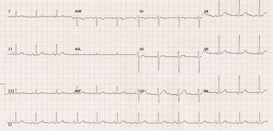 ECG benign early repolarisation, sinus rhythm