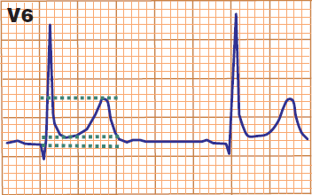 ECG benign early repolarisation ST/T ratio