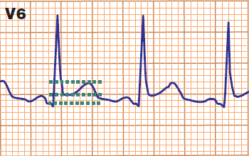 ECG pericarditis ST/T ratio