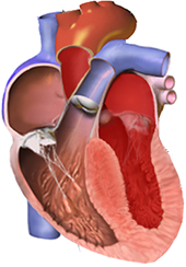 left ventricle concentric hypertrophy