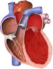 left ventricle eccentric hypertrophy