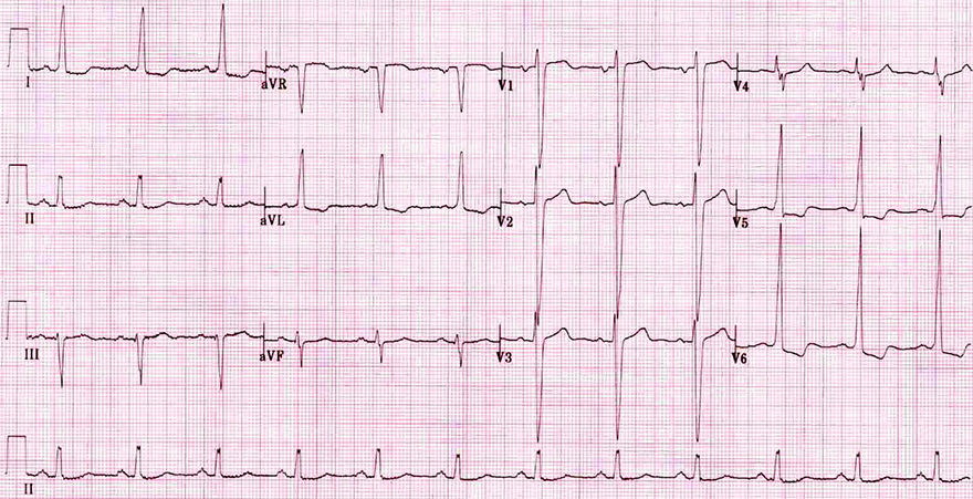 ECG left ventricular hypertrophy, voltage criteria, increased LV voltages, r wave peak time, LV strain pattern, ST elevation, left axis deviation