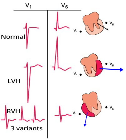 ECG pattern features V1, V6, left ventricular hypertrophy, right ventricular hypertrophy