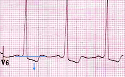 ECG Left ventricular strain pattern, ST depression, T wave inversion in lateral leads
