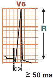 ECG R Wave Peak Time (Intrinsicoid Deflection), left ventricular hypertrophy