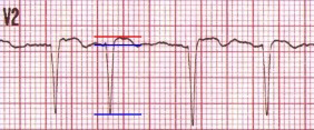 ECG (V2) T/QRS ratio, distinguishes ventricular aneurysm from anterior STEMI myocardial infarction