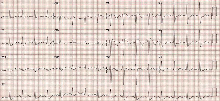 ECG Brugada syndrome type I, J wave, ST segment, T wave