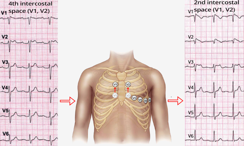 ECG diagnosis of Brugada syndrome, ECG leads V1 and V2 are moved to the 2nd intercostal space