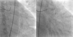 coronarography LAD video (movie). Wellens syndrome, Windowmaker artery