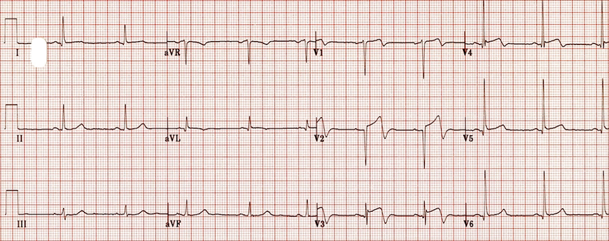 ECG Wellens syndrome type A (type II), Biphasic precordial T waves with terminal negativity (V2-V3)