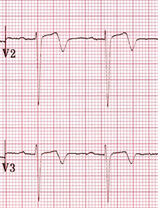 ECG wellens syndrome Type II (Type A), Biphasic, with initial positivity & terminal negativitye