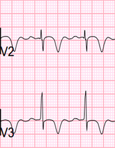 ECG Wellens syndrome type I (Type B), deeply symmetrically negative T waves
