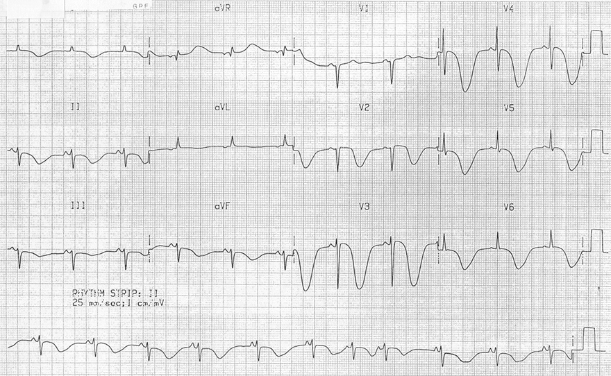 ECG subarachnoid haemorrhage (SAH), Intraparenchymal haemorrhage (haemorrhagic stroke), cerebral T waves