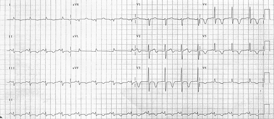 ECG inverted, inversion, giant cerebral T waves, subarachnoid haemorrhage (SAH), prolonged QT interval