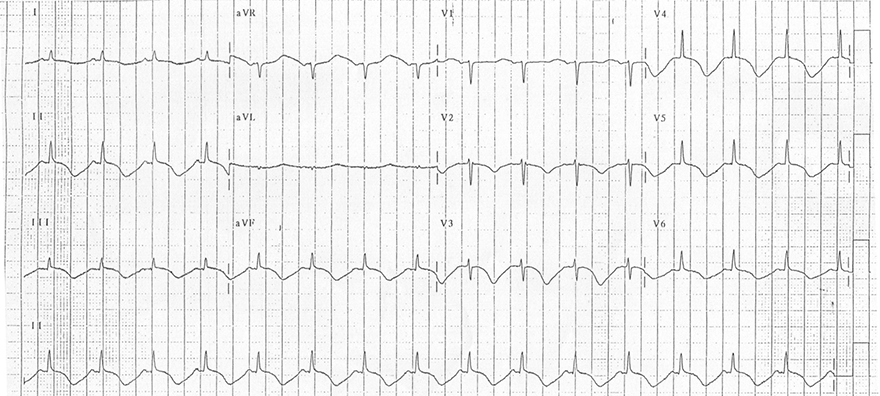 ECG subarachnoid haemorrhage (SAH), Raised intracranial pressure, cerbral T waves, giant T waves inversion