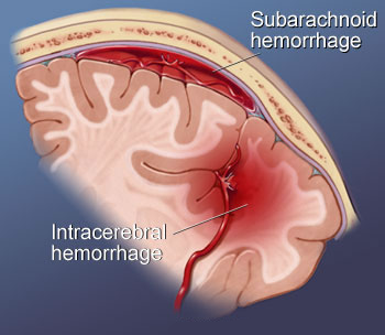 Subarachnoid hemorrhage, Intraparenchymal hemorrhage (hemorrhagic stroke)