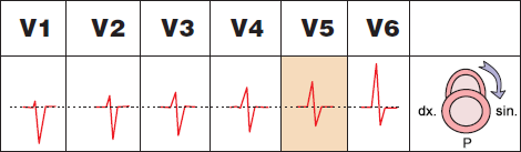 ECG precordial leads and Clockwise (CW) rotation, cor pulmonale, Chronic obstructive pulmonary disease