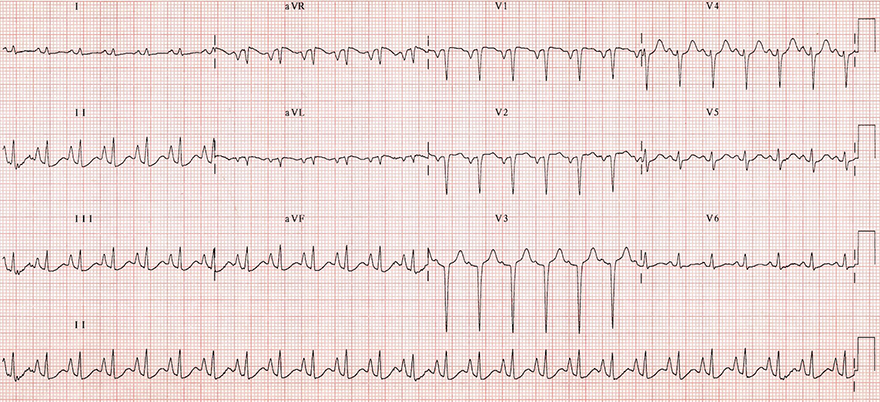 ECG chronic obstructive pulmonary disease, rightward QRS axis, clockwise rotation, low voltages