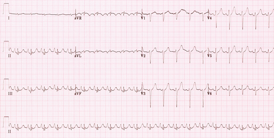 ECG chronic obstructive pulmonary disease, P pulmonale, rightward QRS axis, clockwise rotation, low voltages