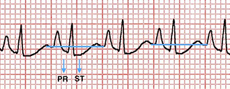 ECG right strain pattern, cor pulmonale, Chronic obstructive pulmonary disease, Sagging of the PR and ST segments below the TP baseline