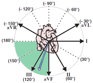 Electrical vector and right axis deviation, cor pulmonale, Chronic obstructive pulmonary disease