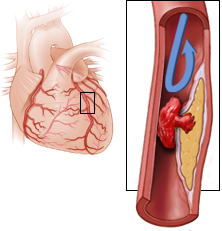 LAD occlusion, De Winter T waves