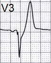 ECG de winter T wave