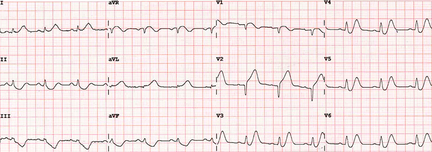 ECG De Winters T waves and anterior STEMI infarction