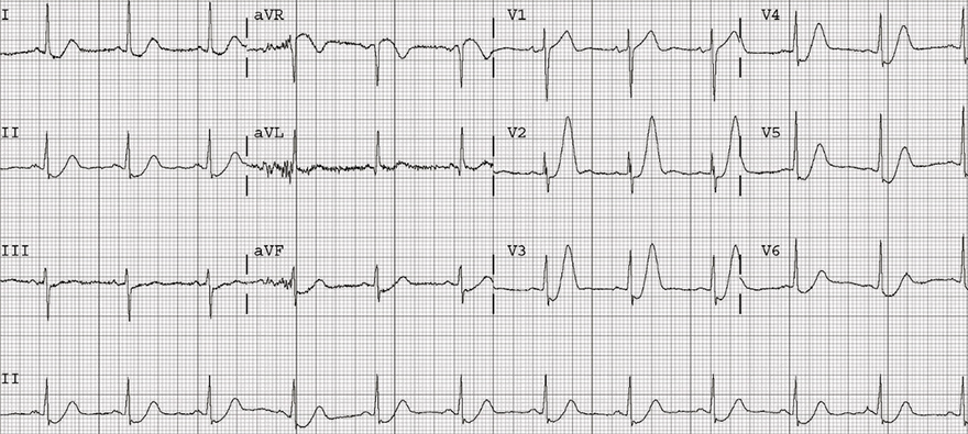 ECG De Winters T waves, upsloping ST depression, Peaked anterior T waves, Subtle ST elevation aVR