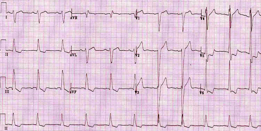ECG biventricular hypertrophy, Katz-Wachtel phenomenon, Voltage criteria for LVH