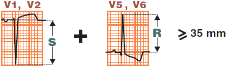 ECG, voltage criteria, Sokolow-Lyon criteria, index, left ventricular hypertrophy