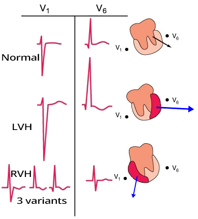 ECG pattern of biventricular hypertrophy, left ventricular hypertrophy, right ventricular hypertrophy